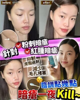 Pios Supreme Instant Spots Remover 瞬時去痘淨膚精華 10ml